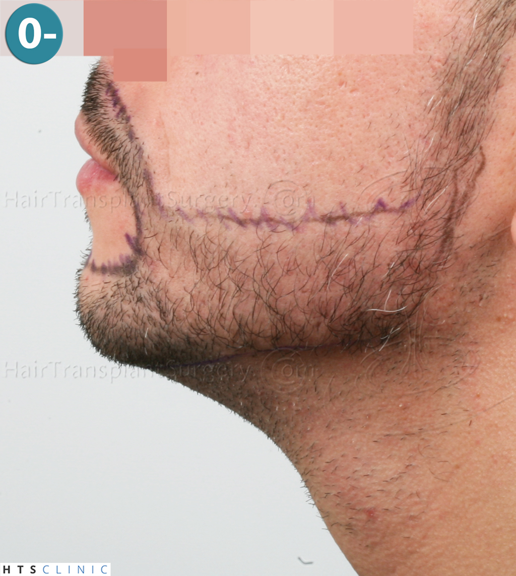 Dr.Devroye-HTS-Clinic-1011-FUE-Beard-6