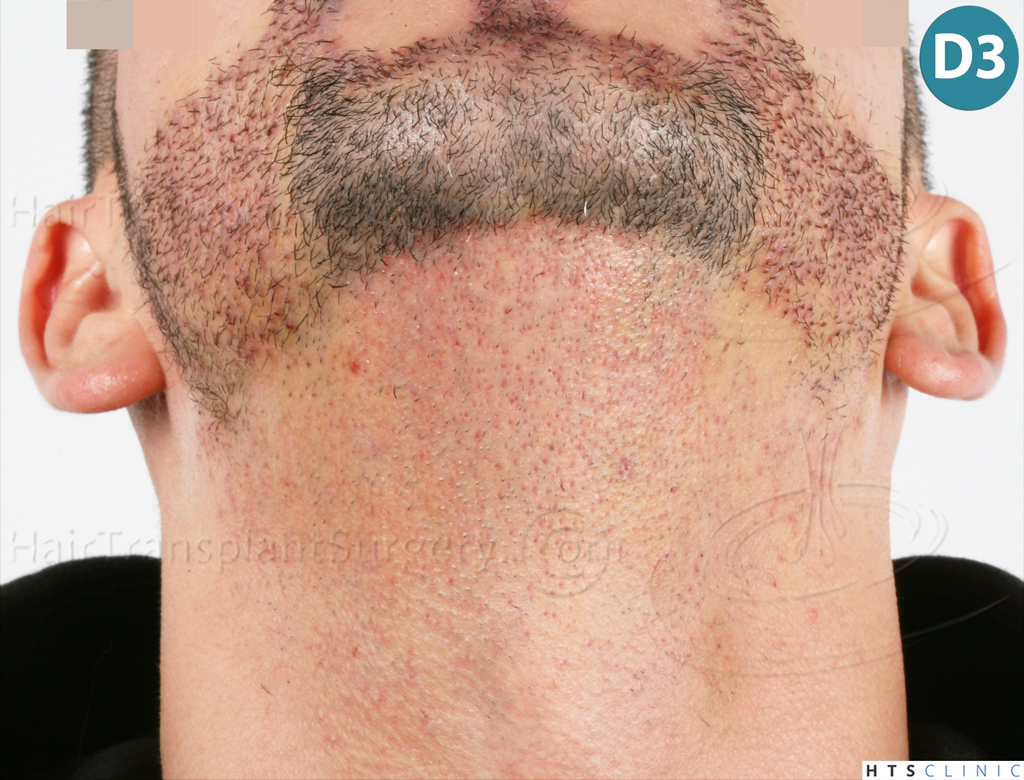 Dr.Devroye-HTS-Clinic-1011-FUE-Beard-15