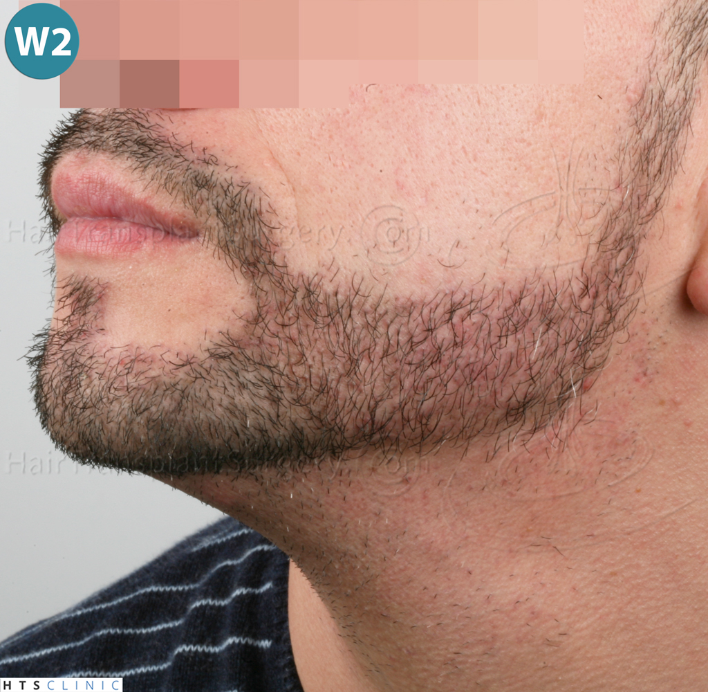 Dr.Devroye-HTS-Clinic-1011-FUE-Beard-17.jpg