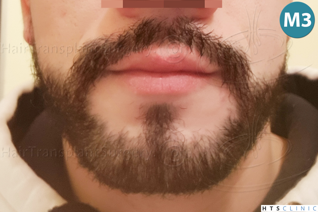 Dr.Devroye-HTS-Clinic-1011-FUE-Beard-20