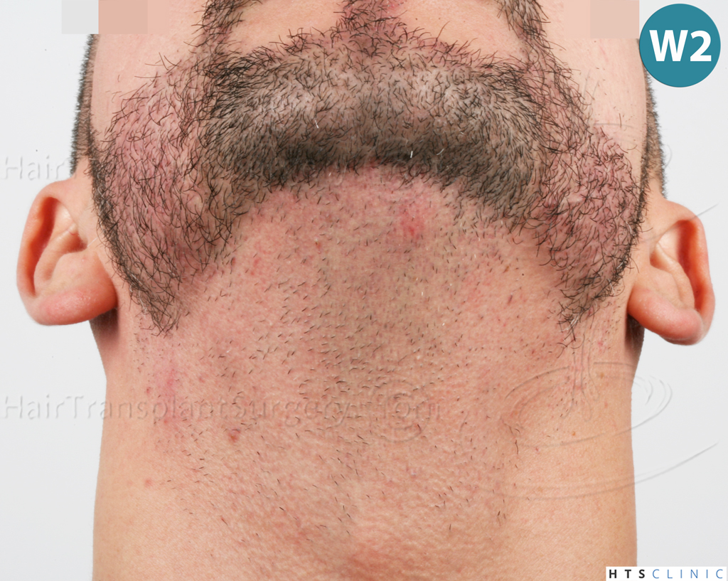 Dr.Devroye-HTS-Clinic-1011-FUE-Beard-19