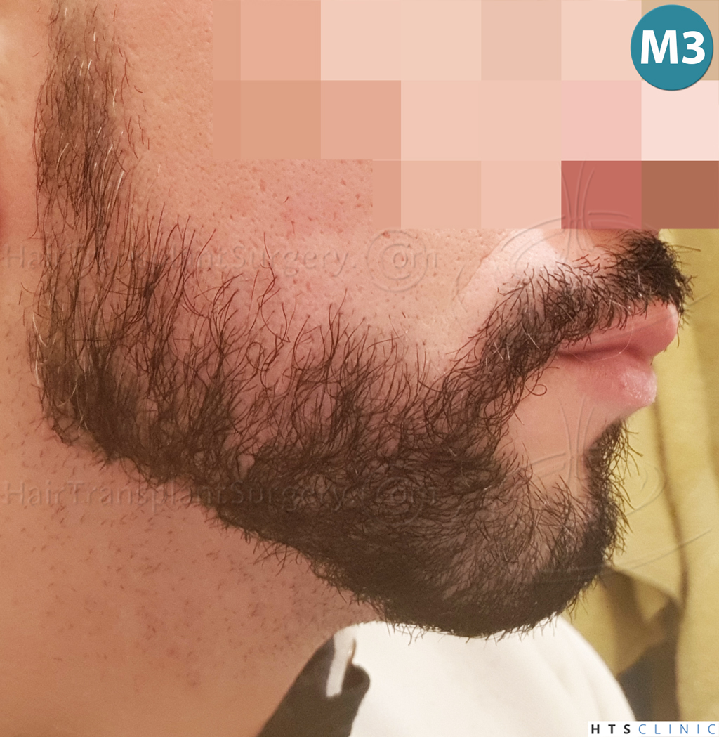 Dr.Devroye-HTS-Clinic-1011-FUE-Beard-22.jpg