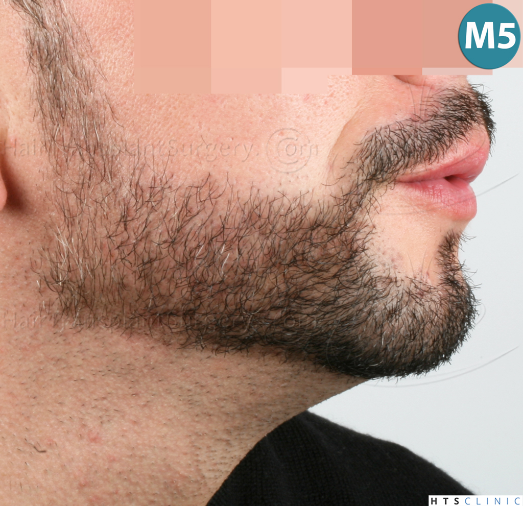 Dr.Devroye-HTS-Clinic-1011-FUE-Beard-25