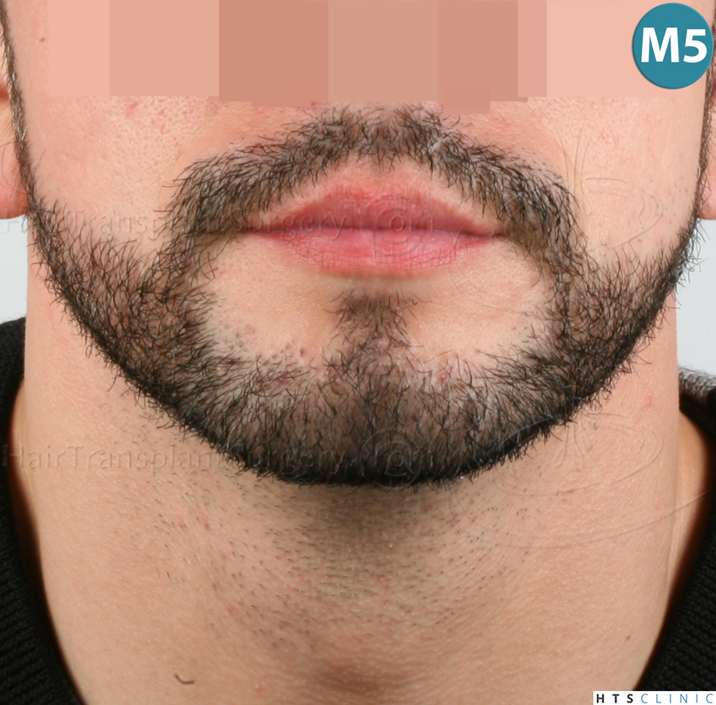 Dr.Devroye-HTS-Clinic-1011-FUE-Beard-23.jpg