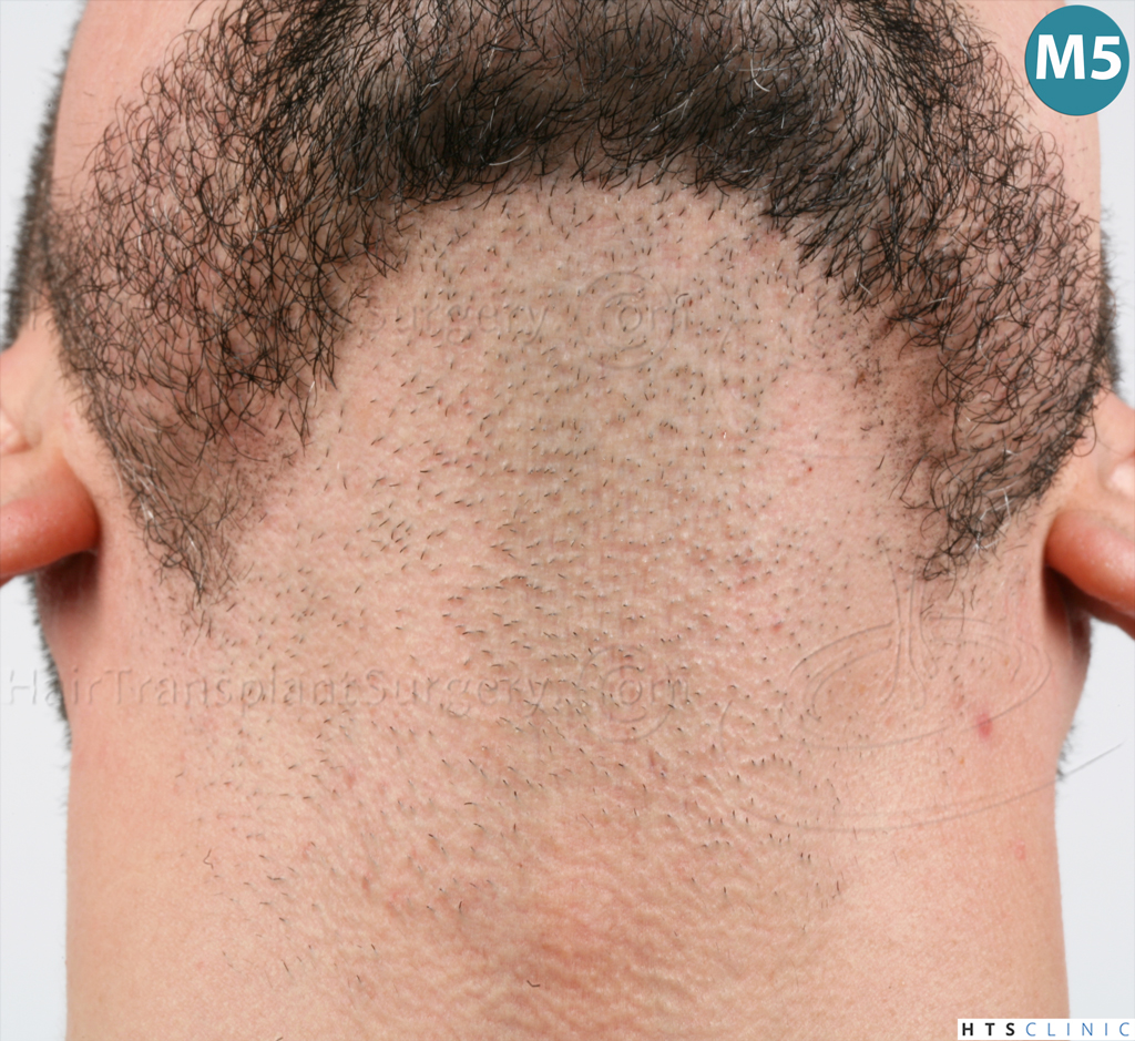 Dr.Devroye-HTS-Clinic-1011-FUE-Beard-26