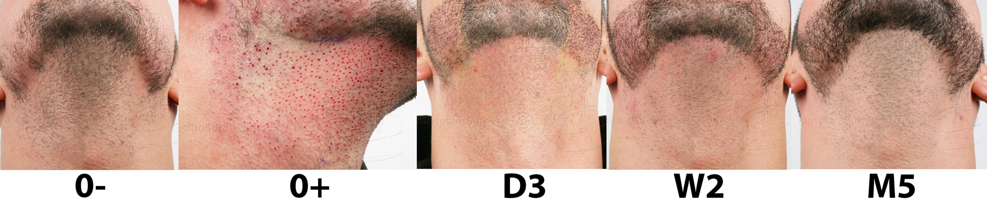 Dr.Devroye-HTS-Clinic-1011-FUE-Beard-Montage4