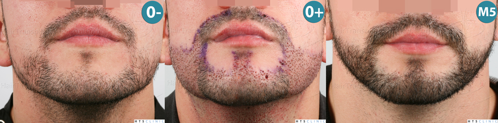 Dr.Devroye-HTS-Clinic-1011-FUE-Beard-Montage1.jpg