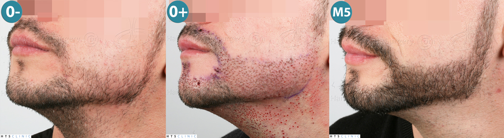 Dr.Devroye-HTS-Clinic-1011-FUE-Beard-Montage2.jpg