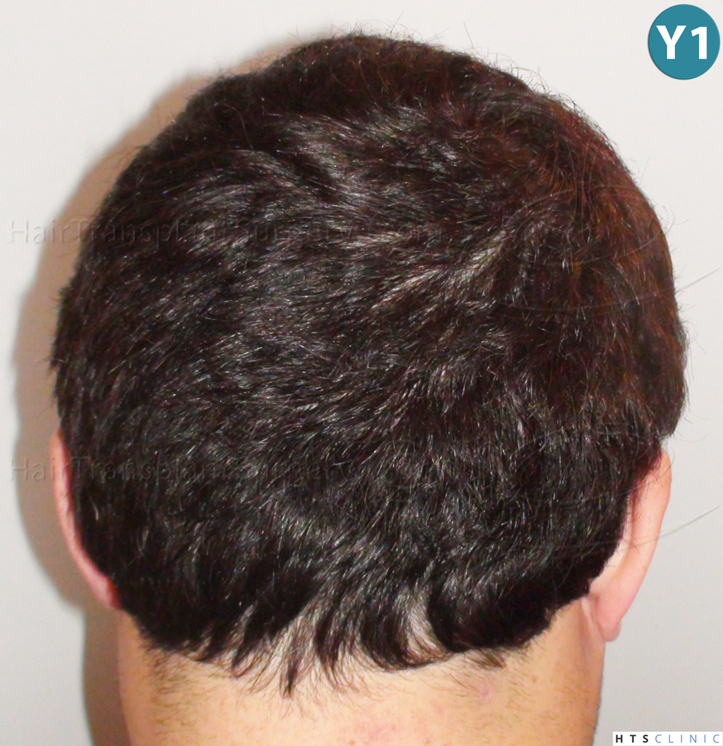 Dr.Devroye-HTS-Clinic-983-FUT-Vertex-8.jpg