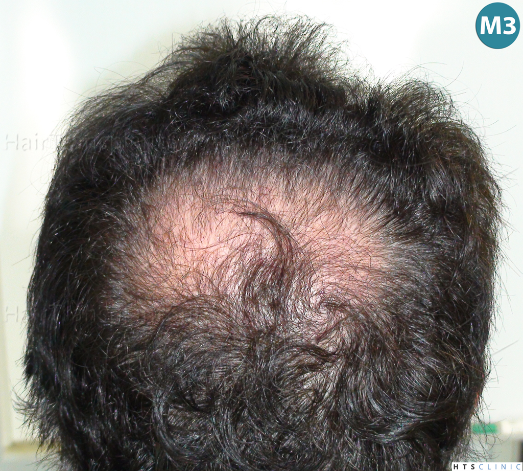 Dr.Devroye-HTS-Clinic-983-FUT-Vertex-6.jpg