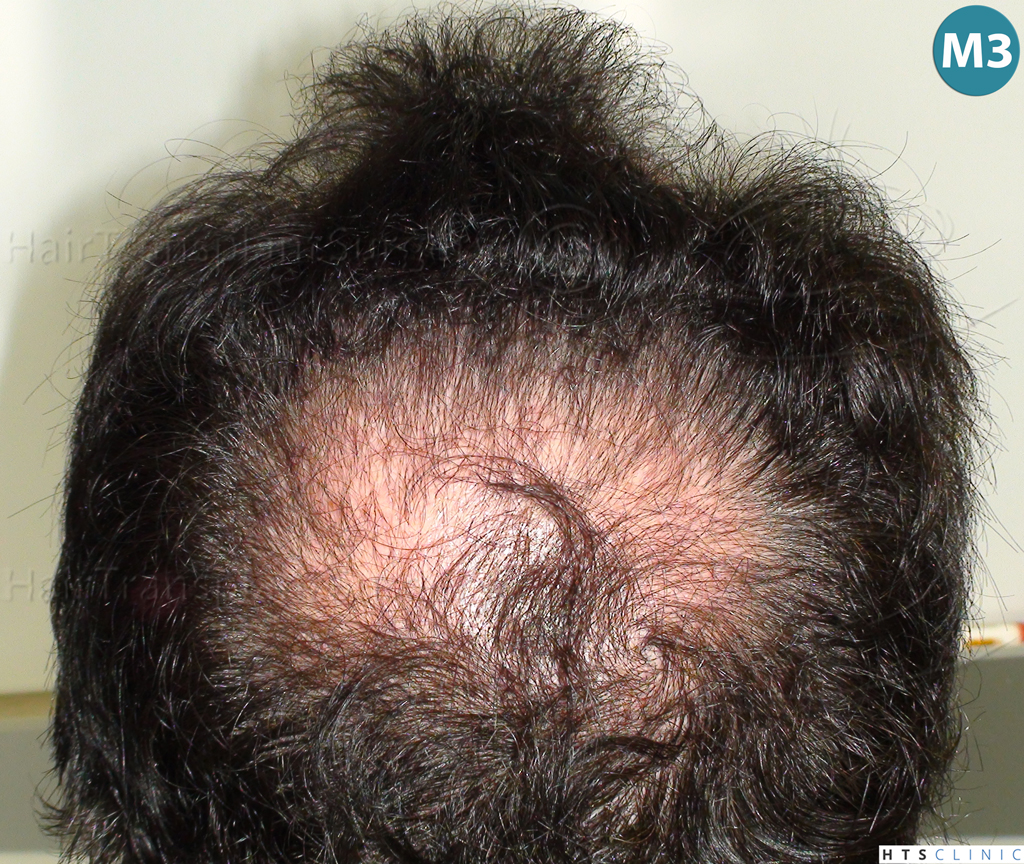 Dr.Devroye-HTS-Clinic-983-FUT-Vertex-7.jpg
