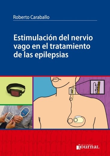 Estimulación del nervio vago en el tratamiento de las epilepsias
