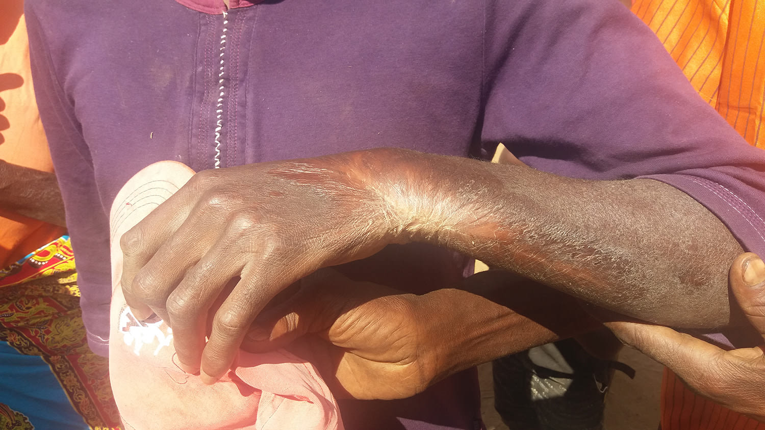 Many people with epilepsy are burned during a seizure; this man has multiple burns.