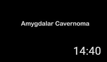 Amygdalar Cavernoma with Dr. Arvind Sukumaran, MCh Neuro (NIMHANS), FPNS, FFENS