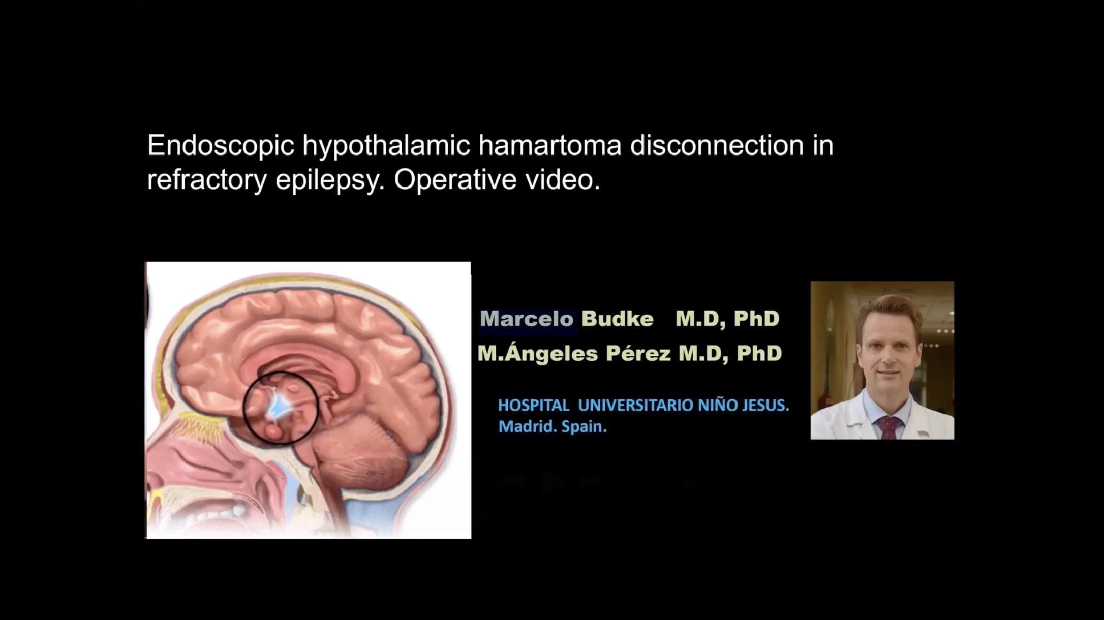Endoscopic hypothalamic hamartoma disconnection in refractory epilepsy — Operative video
Marcelo Budke M.D., PhD
M. Ángeles Pérez M.D., PhD
Hospital Universitario Niño Jesus
Madrid, Spain