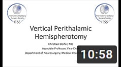 Vertical perithalamic hemispherotomy: Anatomy, Technique, Complications - click for YouTube