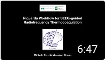 Niguarda Workflow for SEEG-guided Radiofrequency Thermocoagulation
Michele Rizzi and Massimo Cossu
Claudio Munari Center
Ospedale Niguarda