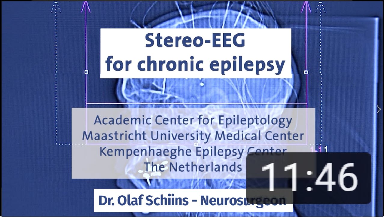 Stereo-EEG for chronic epilepsy