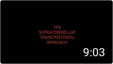 Supracerebellar Transtentorial Approach with Michele Rizzi, Neurosurgeon at the Fondazione IRCCS Istituto Neurologico Carlo Besta in Milano, Italy