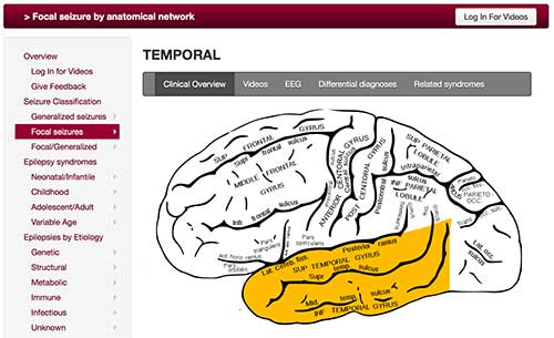 Focal seizures by anatomical network (temporal)