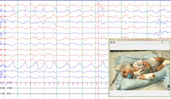 Baby with EEG