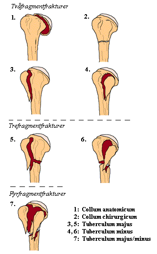 Fractura Tuberculum Majus Humeri () Fractura Tuberculum Majus Humeri