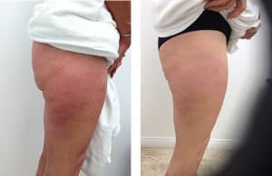 velashape before and after