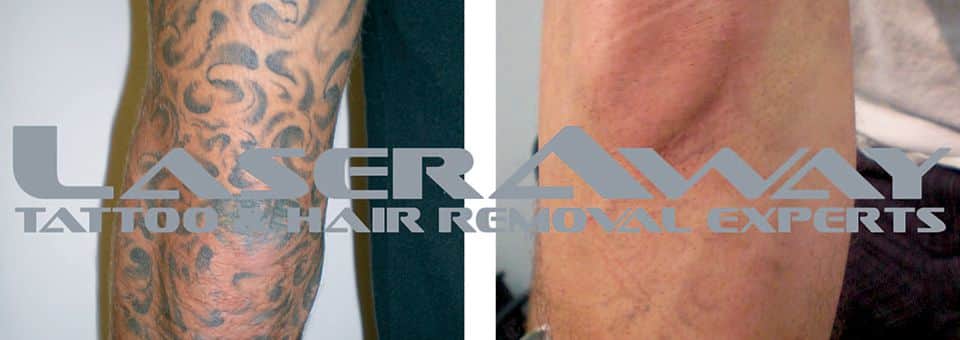 tattoo removal laser differences laseraway tattoo removal laser differences laseraway