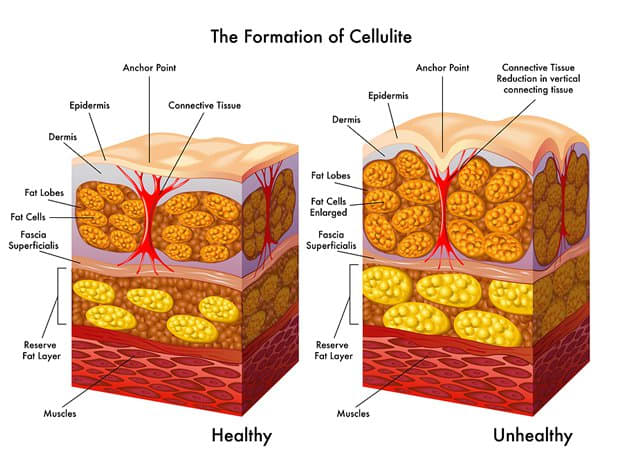 Here are the Best Cellulite Treatments