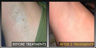 laser hair removal underarm before and after