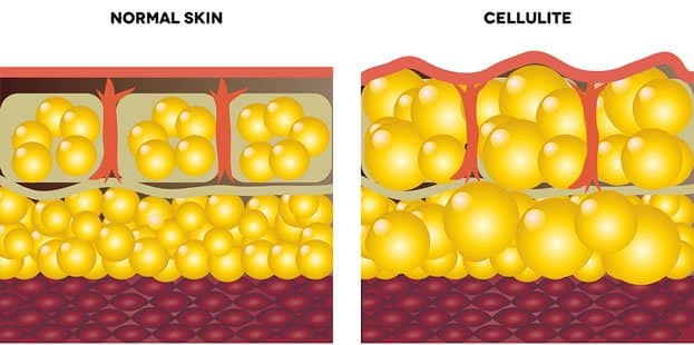 Cellulite Cross Section