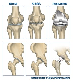 Joint Replacement illustration