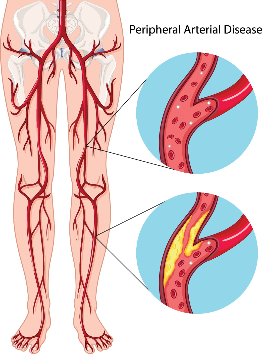 Peripheral Artery Disease diagram (PAD)