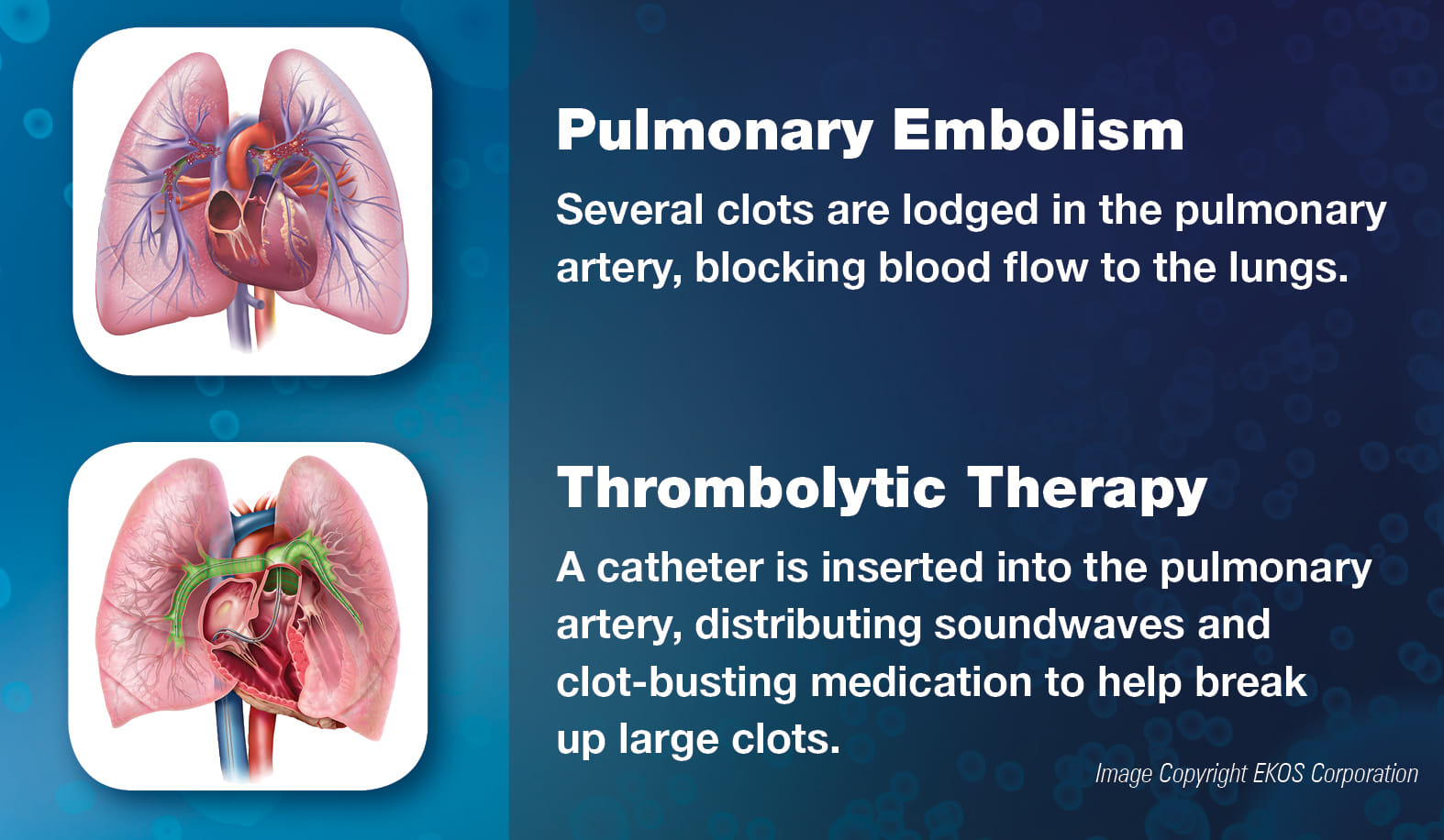 Thrombolytic Therapy stock image from EKOS