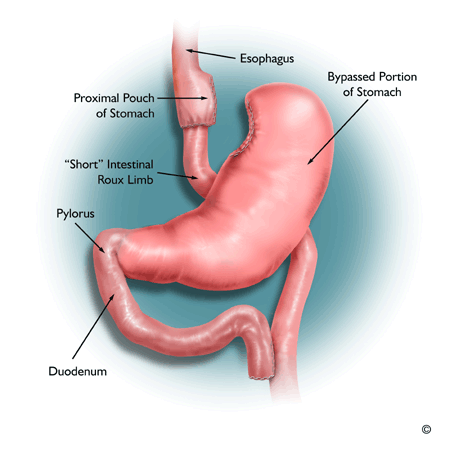 Laparoscopic Gastric Bypass