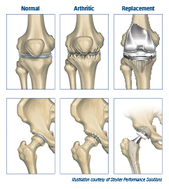 Joint Replacement Illustration