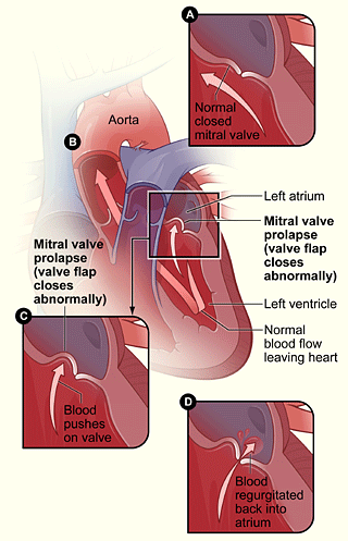 Is a leaky heart valve life threatening?