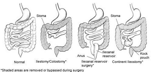 What are some differences between a colostomy and an ileostomy?