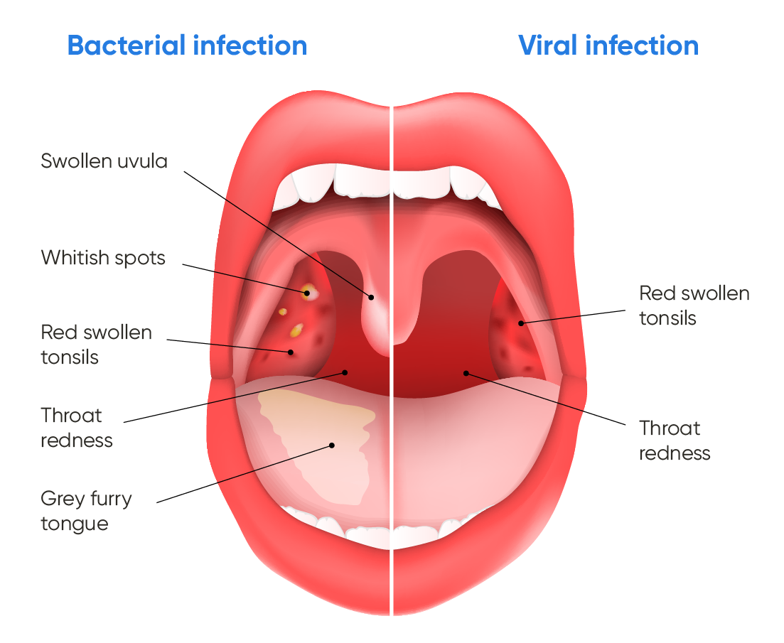 how-to-prevent-recurring-tonsillitis-rivermap