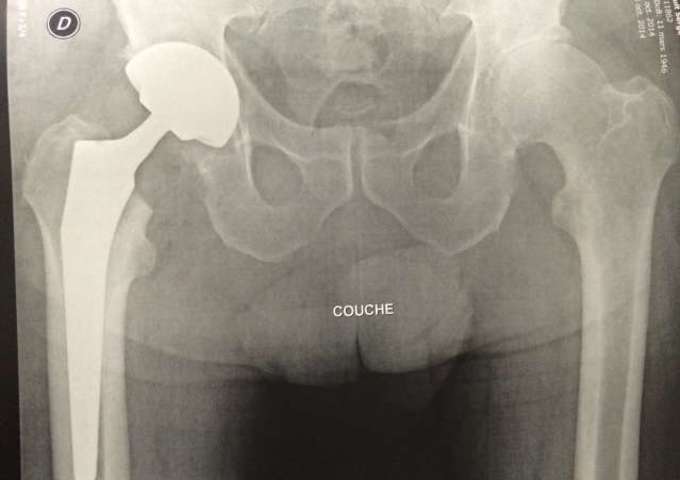 PTH Mini invasive Rottinger