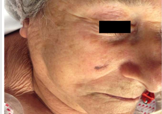 Chirurgie dermatologique