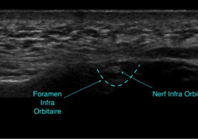 Locoregional anesthesia for oculoplastic surgery