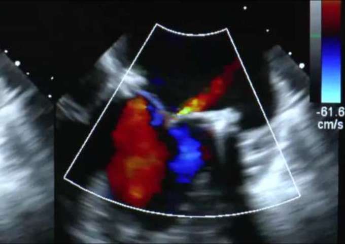 Échocardiographie en Anesthésie-réanimation-urgence