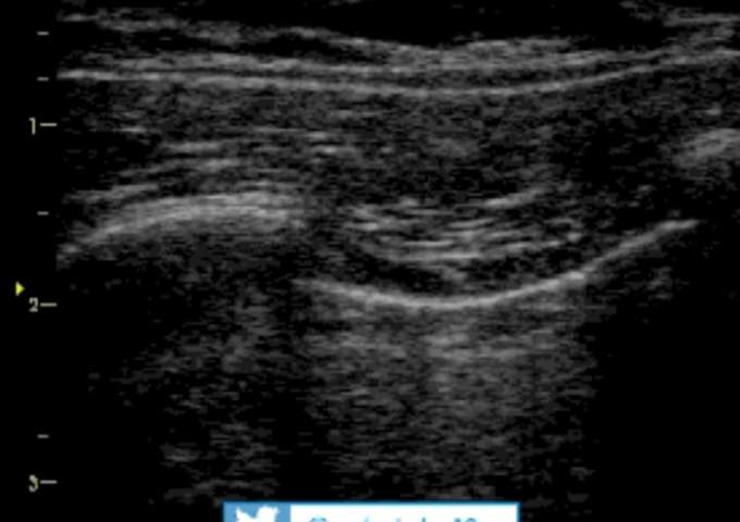 eFAST: abdo, vasculaire, pulmonaire...