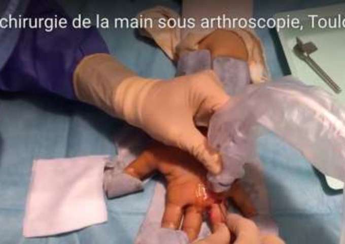 Doigt à ressaut sous échographie