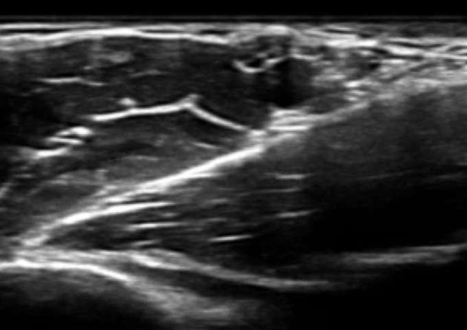 Ultrasound-guided peripheral RA - beginner level, for 2 days