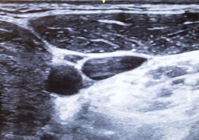CATHETER PERI-NERVEUX ET CHIRURGIE ORTHOPEDIQUE LOURDE EN AMBULATOIRE