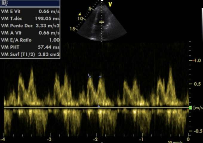 Echographie cardiaque