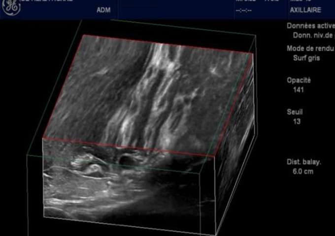 Bloc Axillaire Echoguidé Injection sous paraneurale