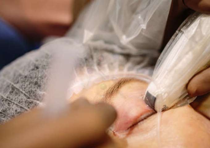 ALR en ophtalmologie Echoguidée